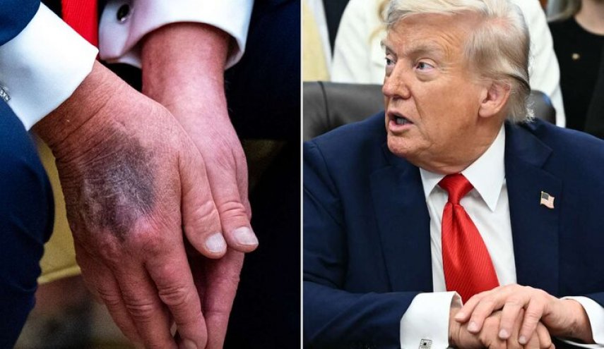 پزشک فیزیوتراپیست: شاید فقط ۲ تا ۴ سال از عمر ترامپ باقی مانده باشد